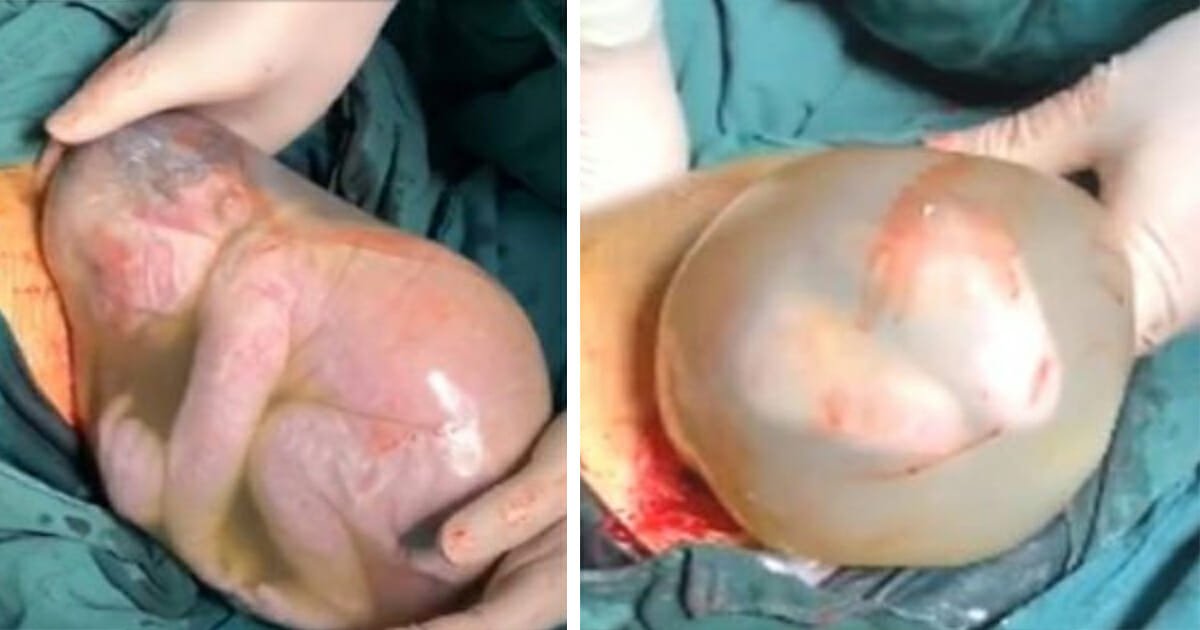 Baby born inside his amniotic sac doesn't breathe for two minutes after emergency C-section