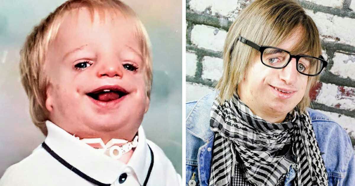 Boy born with no ears and no cheekbones bullied into tears at school, has the last laugh
